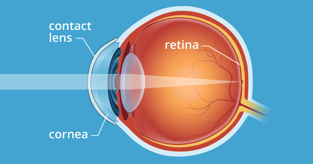 Working of contact lenses - A brief about contact lenses - The Global Eye Hospital