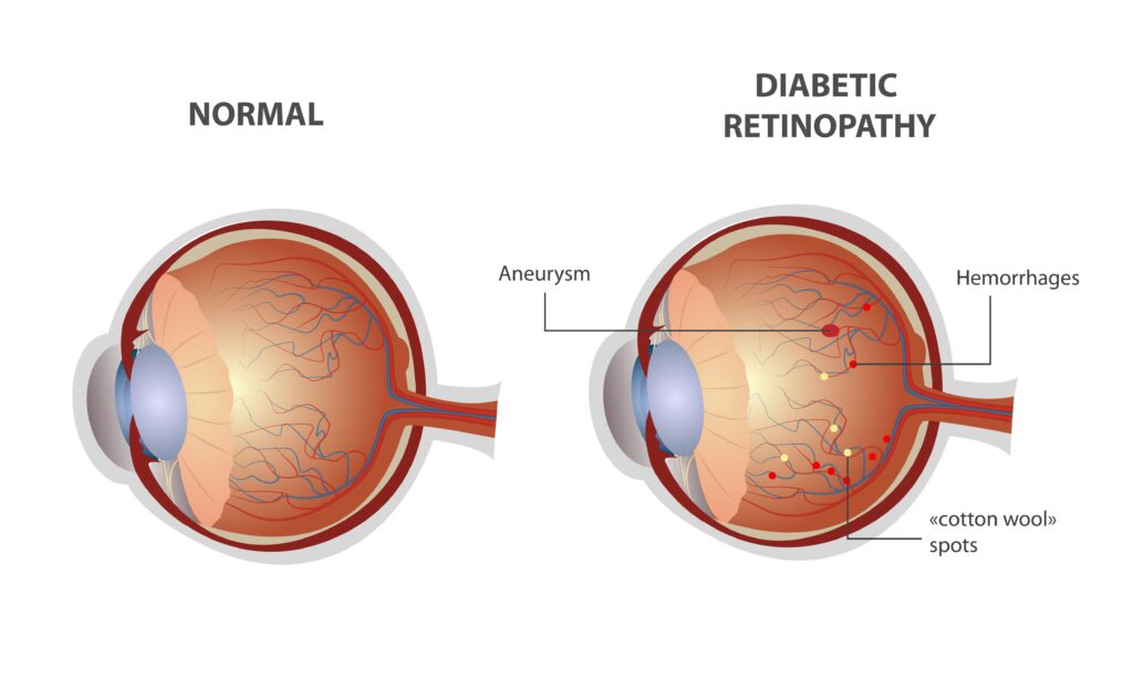 What are the types of diabetic retinopathy? Global Eye Hospital