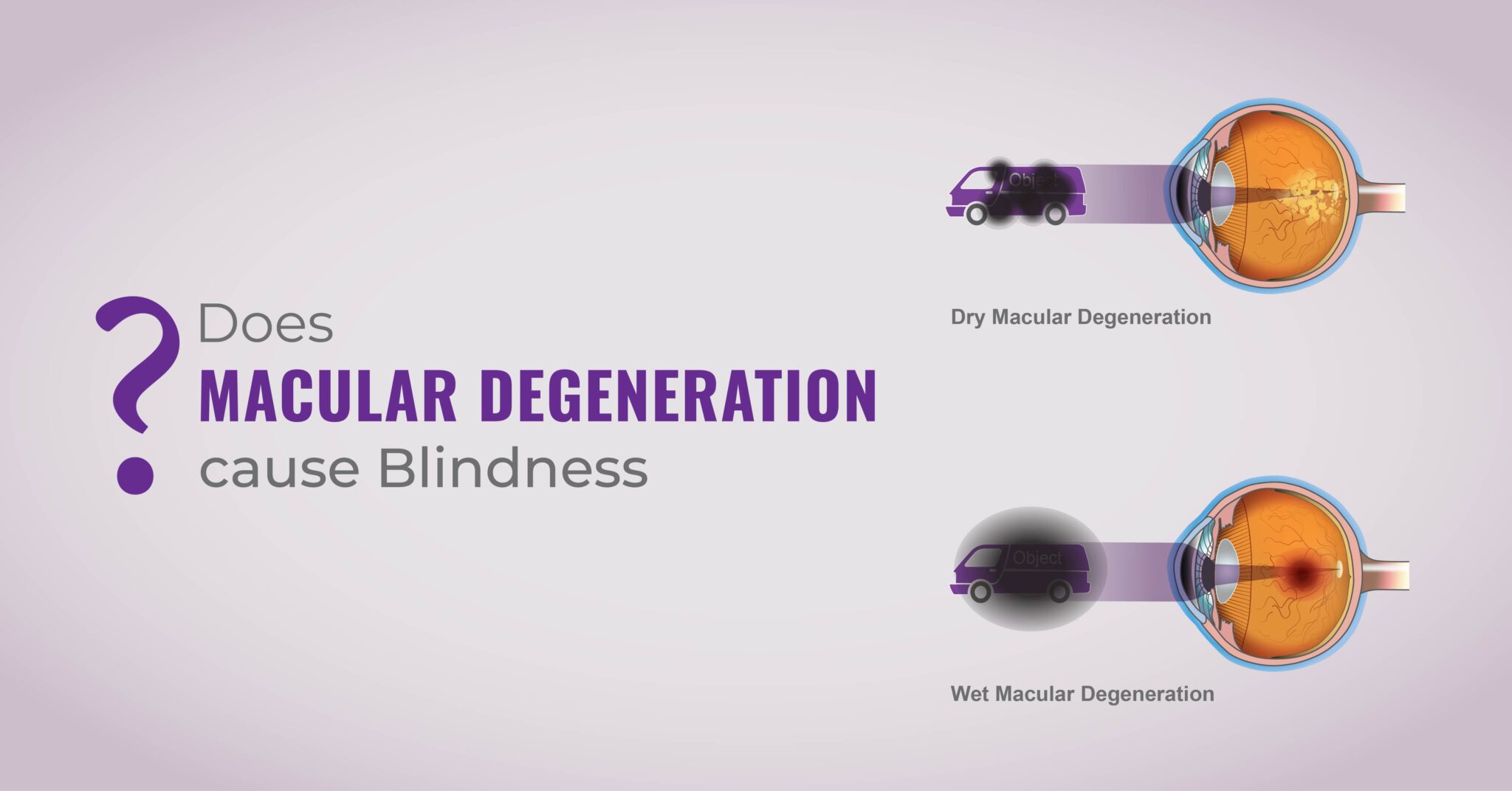 Does macular degeneration cause blindness? Global Eye Hospital
