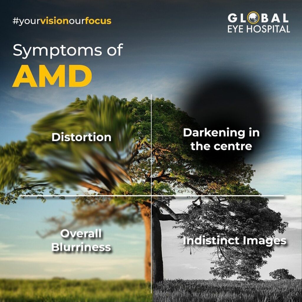 Does macular degeneration cause blindness? Global Eye Hospital