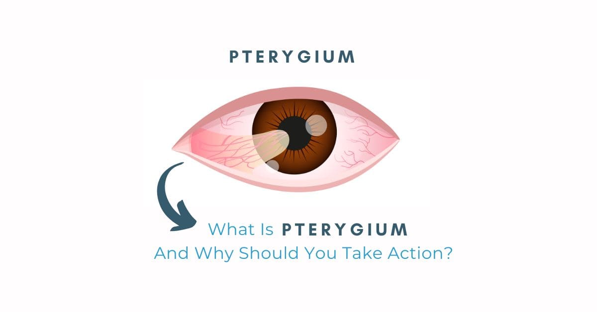 What Is Pterygium, And Why Should You Take Action?