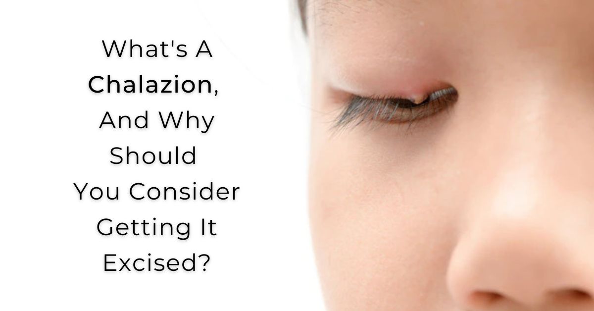 What's A Chalazion? Why Should You Get It Excised?