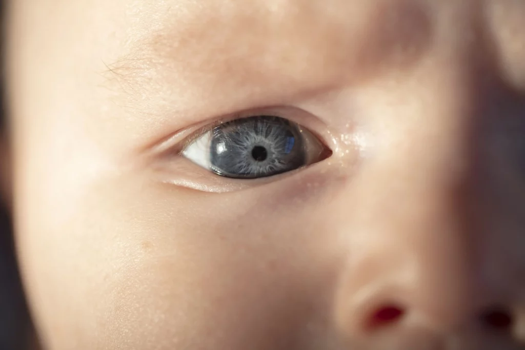 Cataracts in Children Causes, Symptoms, and Treatment