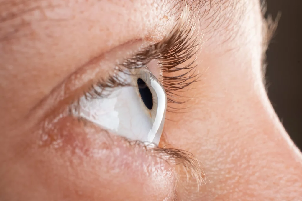 The Diagnosis of Keratoconus What to Expect During Your Eye Exam - Keratoconus - Global Eye Hospital
