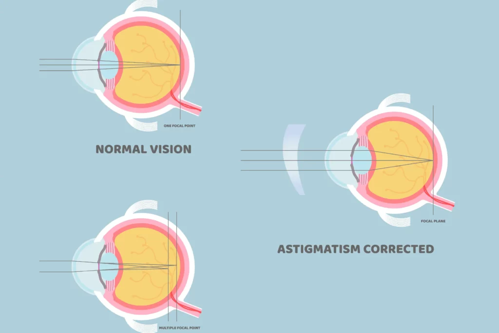 Astigmatic Keratotomy AK Correcting Astigmatism Global Eye Hospital Astigmatic Keratotomy AK Correcting Astigmatism Global Eye Hospital